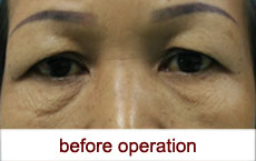 plastic-surgery-blepharoplasty